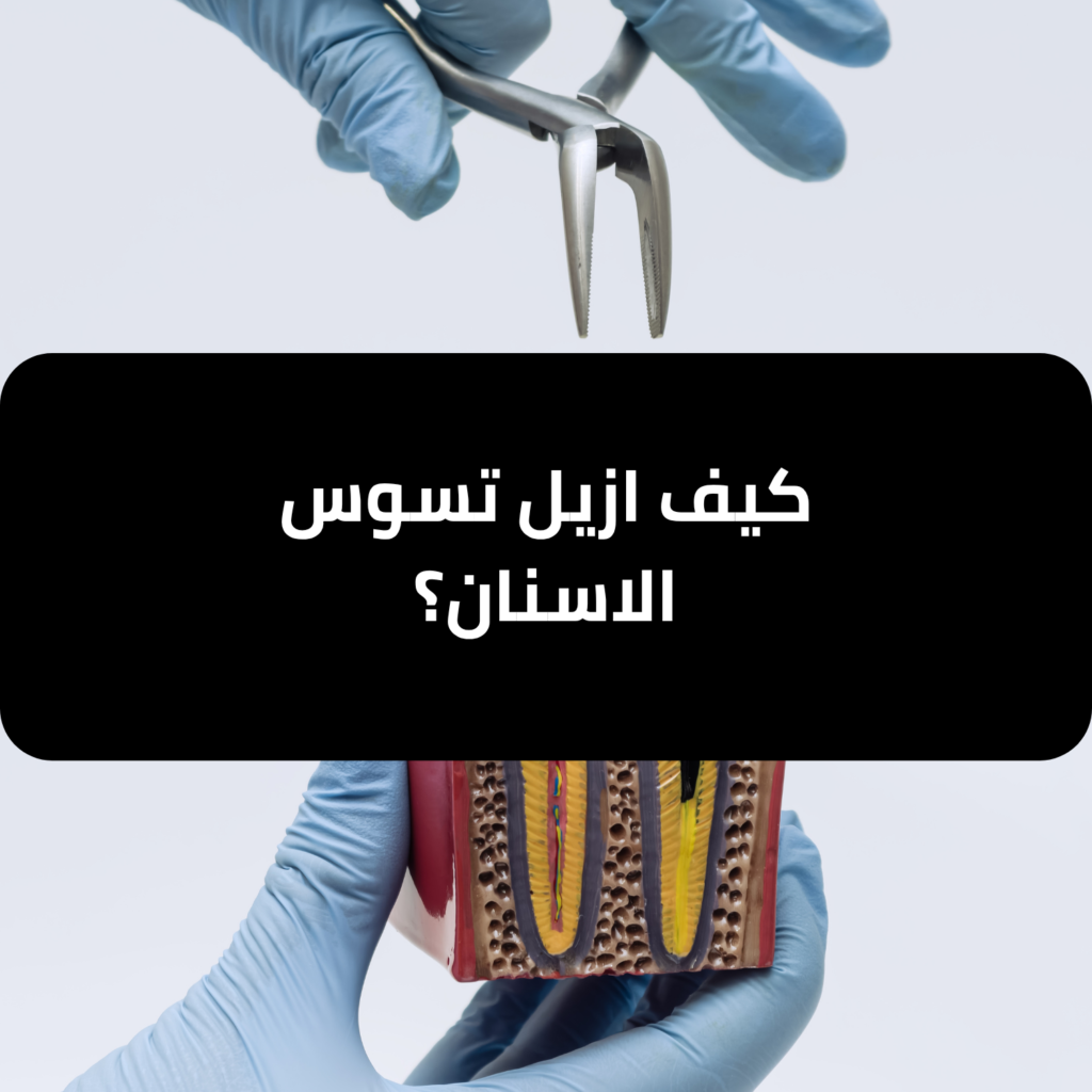 كيف ازيل تسوس الاسنان​ ؟ - مجمع لجين الصحة الطبي المتخصص