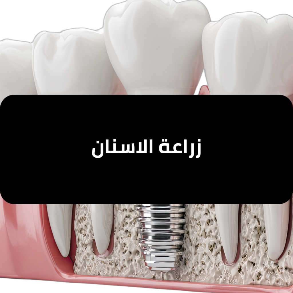 زراعة الأسنان ما هي وكيف تتم؟ دليل شامل - مجمع لجين الطبي